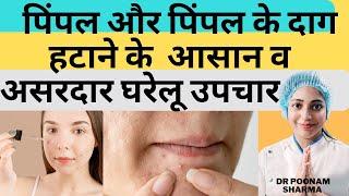 पिंपल और पिंपल के दाग को हटाने के आसान और असरदार घरेलू उपचार | Home Remedies to Remove Pimples