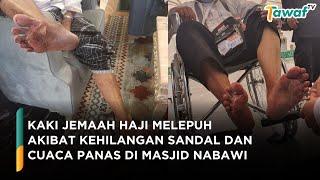 Kaki Jemaah Haji Indonesia Melepuh, Ini Penyebabnya