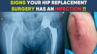 What are the signs of infection in a THR? #totalhipreplacementsurgery || Dr Pankaj Walecha