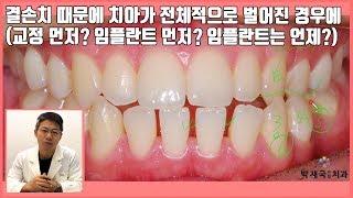 [대전 투명교정, 대전 임플란트] 결손치 때문에 치아가 전체적으로 벌어진 경우에 (교정먼저? 임플란트먼저? 임플란트는 언제?)