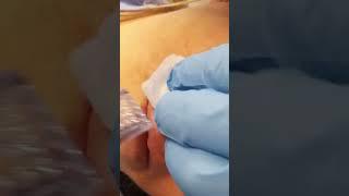 Facial Mole Removal - Amazing Patient Reaction   #nonsurgical #mole #moleremoval #radiosurgery