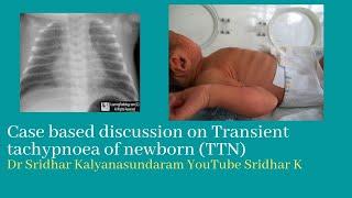 TTN. Transient tachypnoea of newborn. Dr Sridhar Kalyanasundaram