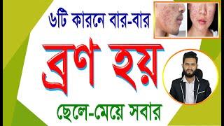 ৬ কারনে বার বার ব্রণ হয়। ছেলে মেয়ে সবারই। Physical care bangla pro