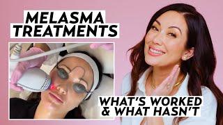 My Melasma Treatment Journey: What Actually Worked to Treat Hyperpigmentation | Skincare Susan Yara