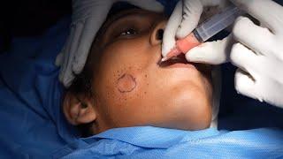 Fat grafting | Facial fat grafting | Surgical procedure