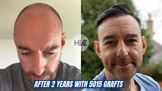 Hair Transplant before and after with 5015 Grafts, Amazing Result