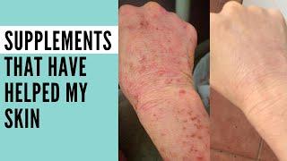 What supplements did I use to heal my eczema?