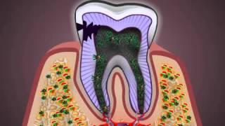 What is Pulpitis