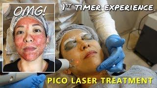 PICO Laser Treatment | 1st Timer's Experience | Kat L