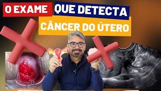 O melor exame que detecta o câncer de útero