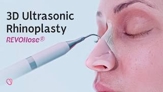 REVONose® – 3D Ultrasonic Feminization Rhinoplasty