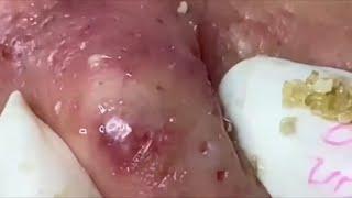 Popping huge blackheads and Pimple Popping - Best Pimple Popping Videos 61