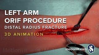 Left Arm ORIF Procedure of Distal Radius Fracture - 3D Medical Animation