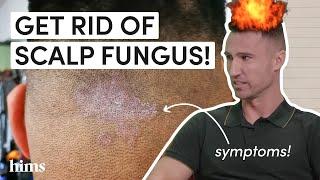 SCALP INFECTION? A Doctor Explains How You Get Scalp Fungus (and How to Treat It)