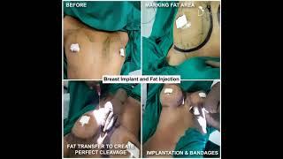 Fat Transfer to Create Perfect Cleavage | 335 CC Sebbin Silicone Breast Implant