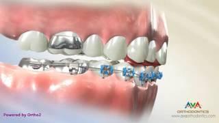 Orthodontic Treatment for Deepbite - Fixed Bite Plate on Front Teeth