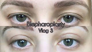 My Eyelid Surgery Stitches Come Out | Cosmetic Blepharoplasty Diary Part 3