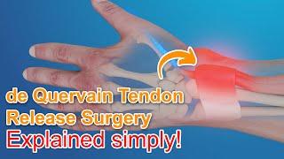 De Quervain Tendon Release Surgery - Explained