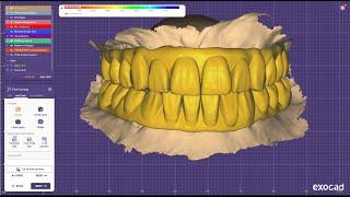 Titanium bar designing for upper screw retained implant in Exocad elefsina