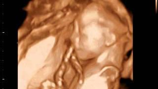 3D Ultrasound  - baby 20 weeks -3D Sono Image