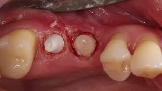 Placing Two Z-Systems Implants in the Upper Jaw of a Lady