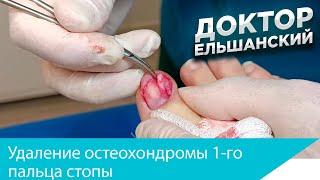 Удаление остеохондромы 1 го пальца стопы