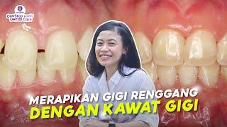 MERAPIKAN GIGI RENGGANG DENGAN KAWAT GIGI ALA DOKTER SPESIALIS ORTHO