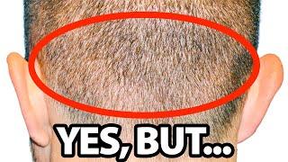 Does FUE Hair Transplant Leave SCARS? | Dr. Gary Linkov