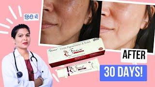 Freia Cream For Pigmentation & Scars Anti Marks Skin Cream Full Review