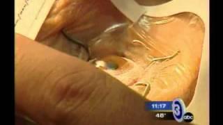 Toledo Lasik.avi