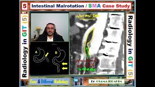 Intestinal malrotation and RLRV (Radiology in GIT -5)