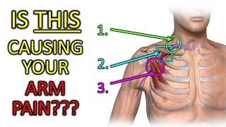 Fix Thoracic Outlet Syndrome: Is THIS Causing Your Arm Pain or Tingling?