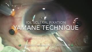 IOL scleral fixation (modified Yamane technique) - Author: Bernardo Moraes MD