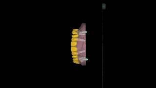 FP1 temporary 3D printed bridge#dental #dentalcadcam #digitaldentistry #dentaltechnology