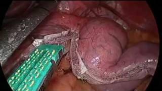 Sleeve Gastrectomy in female BMI 42 by Dr Craig Taylor OClinic