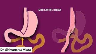 MINI GASTRIC BYPASS SURGERY FOR MORBID OBESITY - A STEP BY STEP NARRATIVE  | DR SHIVANSHU MISRA