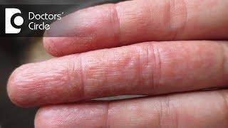 Difference between atopic dermatitis and eczema - Dr. Rashmi Ravindra