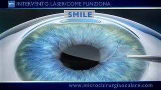 Intervento Laser Occhi: Come Funziona