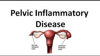 Pelvic Inflammatory Disease (PID)