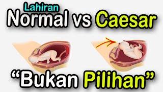 memilih melahirkan normal atau caesar