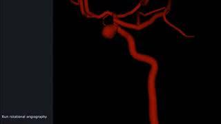 Mentice Neurovascular Coiling   Product Video   short version