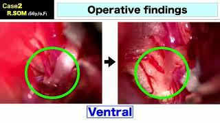 Shusaku Noro - Lateral supracerebellar approach for superior oblique myokymia (Saturday)