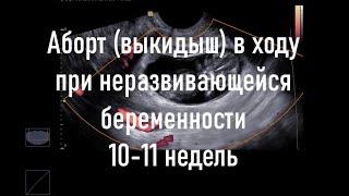 Самопроизвольный аборт в ходу при неразвивающейся беременности 10-11 недель