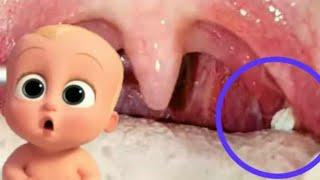 WHAT ARE TONSIL STONES, HOW THEY LOOK & WHAT IS THE TREATMENT #mbbs  #medicoschool