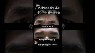 미간주름  영구교정술 사례분석3 #연세자연미성형외과 #필러NO #보톡스N0   #미간필러 #미간보톡스 #신촌성형외과 #홍대성형외과 #은평성형외과 #마포성형외과 #미간주름잘하는곳