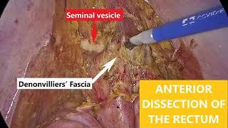 Laparoscopic total mesorectal excision for rectal cancer