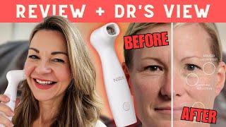 NIRA PRO Laser Review w/ Before and Afters + Would I Use it Long Term?