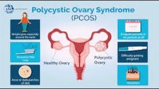 QUICK TIPS TO KNOW IF YOU HAVE PCOS AS A WOMAN