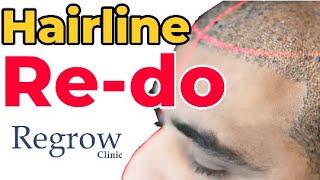 Correction of Bad Hair Transplant || Regrow Clinic || Best Hair Transplant Doctor || +91 9528168089