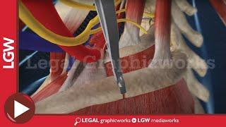 Rib Ressection Thoracic OS Surgery 3D animation